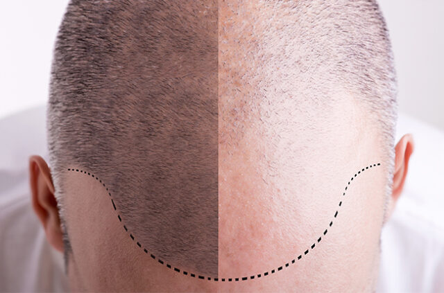 yara-yanik-tedavisi https://www.fibohair.com/wp-content/uploads/2020/08/yara-yanik-tedavisi-640x423.jpg