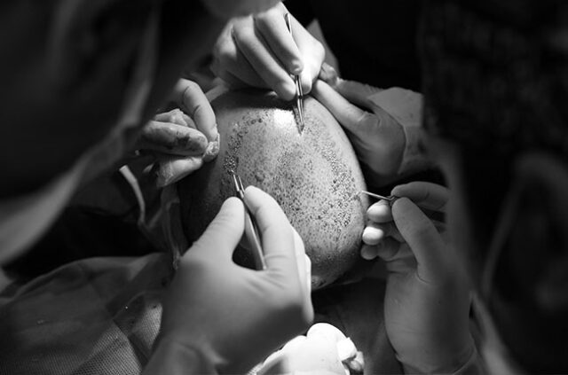 fue-sac-ekimi https://www.fibohair.com/wp-content/uploads/2020/09/fue-sac-ekimi-640x423.jpg